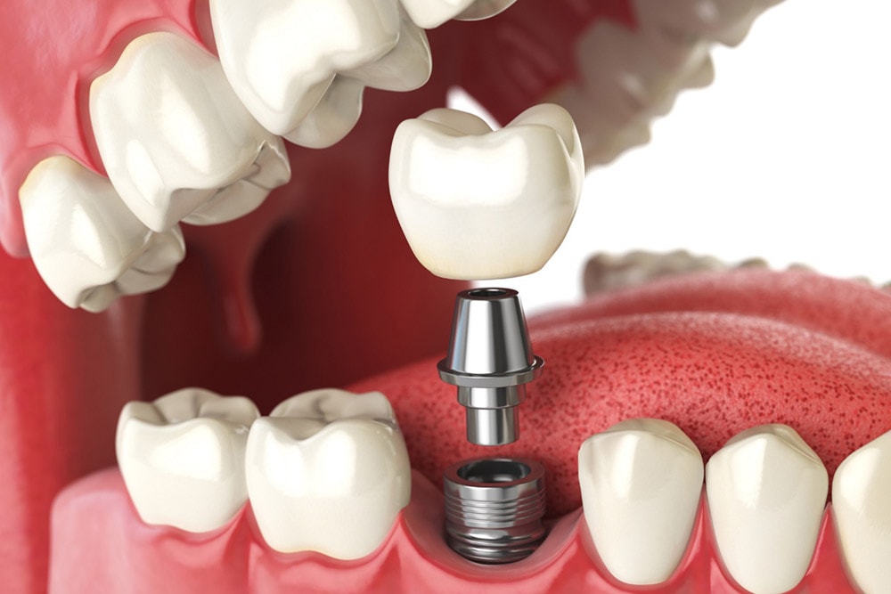 https://m-smile.com.ua/wp-content/uploads/2026/03/Implantatsiya.jpg